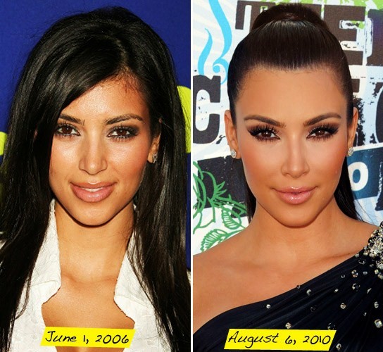 Kim Kardashian "Before" and "After" Plastic Surgery