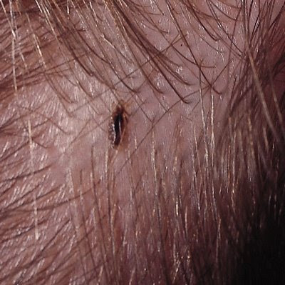 how to check for lice