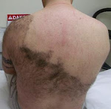 Laser Back Hair Removal