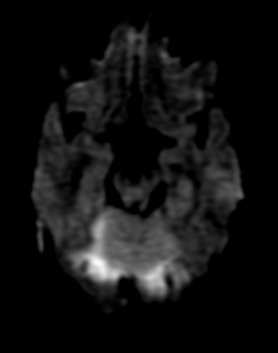 Cholesteatoma+symptoms