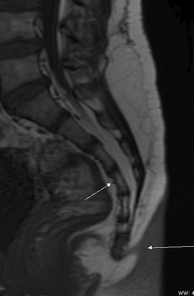 dislocated tailbone dislocated tailbone