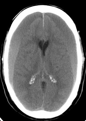 subdural hematoma blown pupil subdural hematoma blown pupil