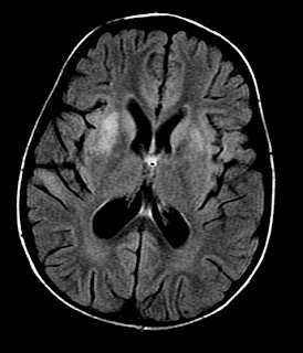encephalitis mri viral radiology diffusion