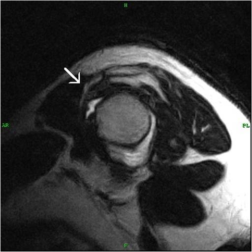 Pulley LesionShoulder MRI Sumer's Radiology Blog