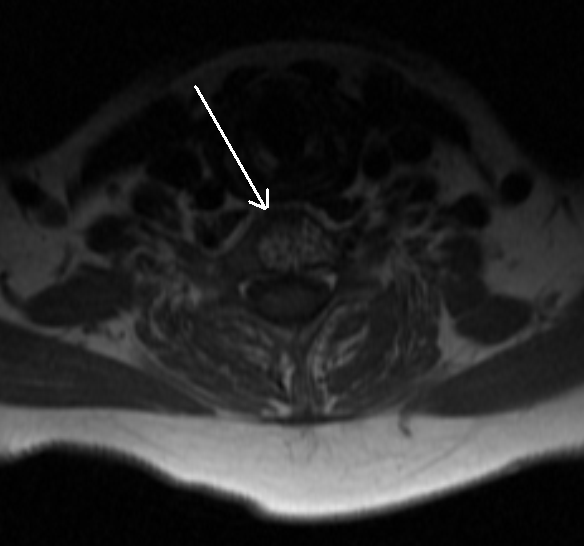 Vertebral Haemangioma_MRI - Sumer's Radiology Blog