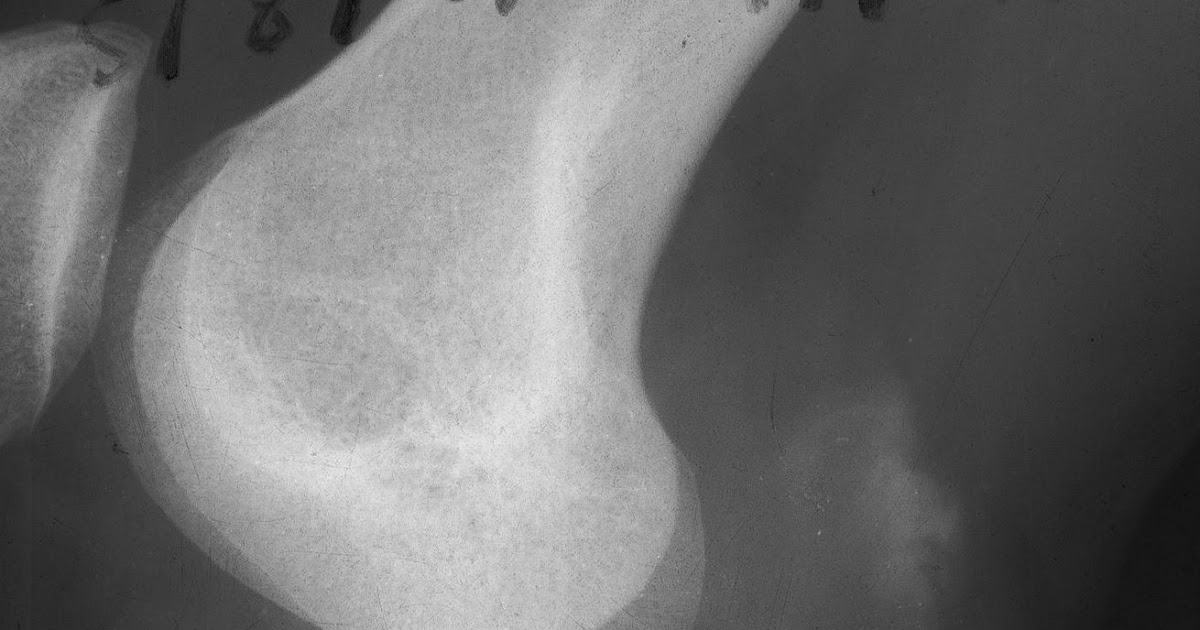 Calcified Baker's Cyst Sumer's Radiology Blog
