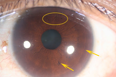 Iridology Stress Rings