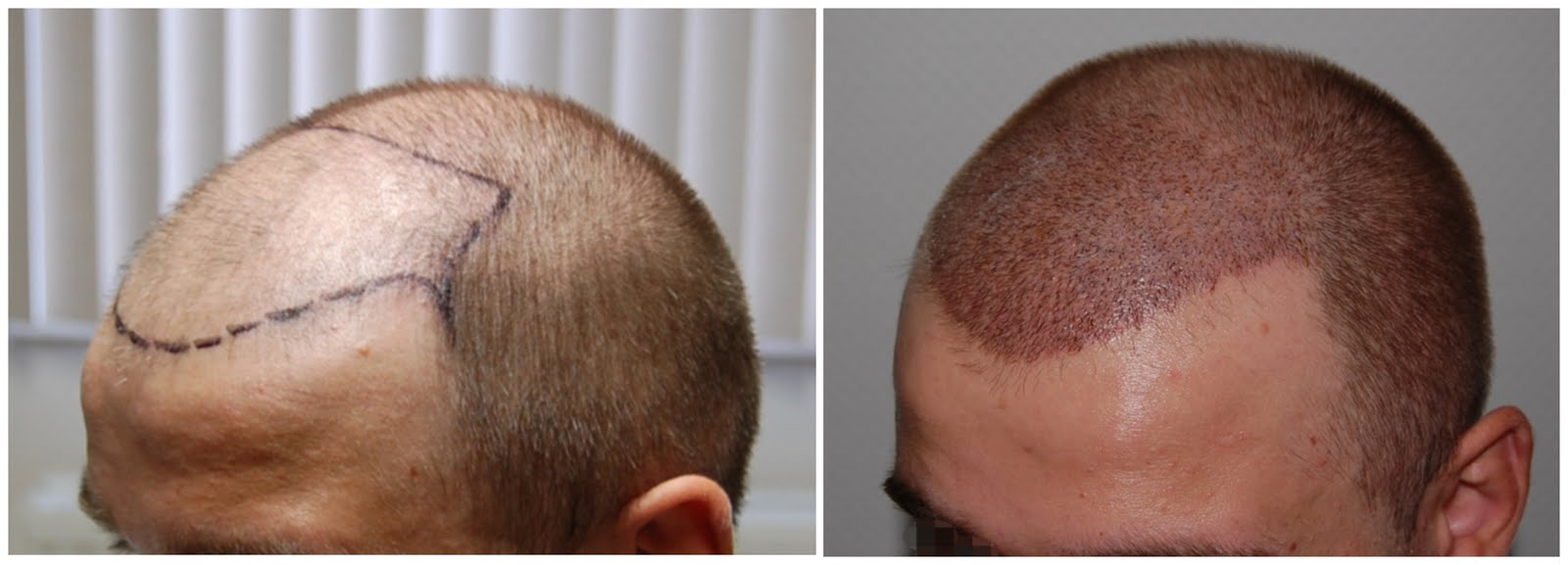 http://2.bp.blogspot.com/_ome05PyQeQ4/TL1ZPFlyDaI/AAAAAAAAAOU/jDcZ19AeJZA/s1600/Haartransplantation+FUE+Seitlich+1.jpg