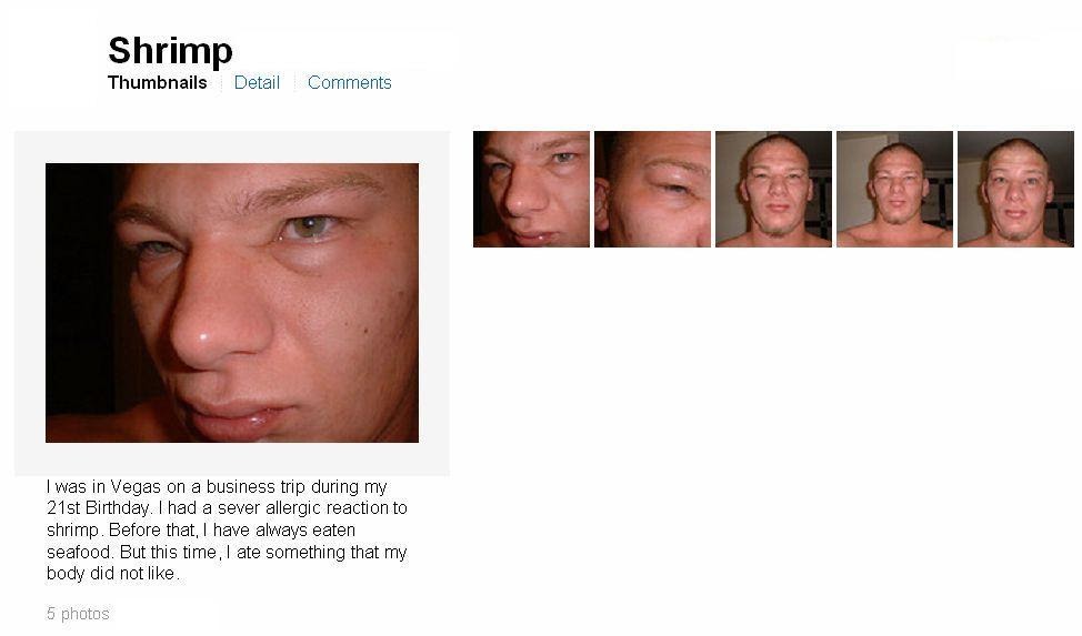 Allergy Notes Allergic Reaction to Shrimp on Flickr