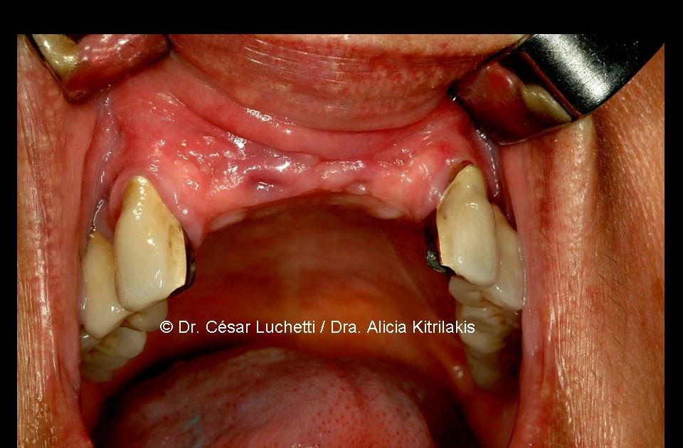 Dental Implants Articles Nasal Cavity Lift