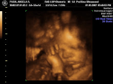 3-D Ultra Sound