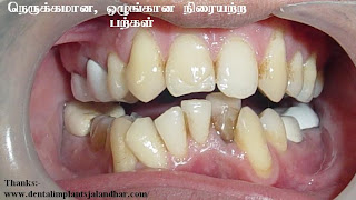 வாய்நாற்றம் ஏன் ஏற்படுகிறது? - Halitosis Irregular+teeth