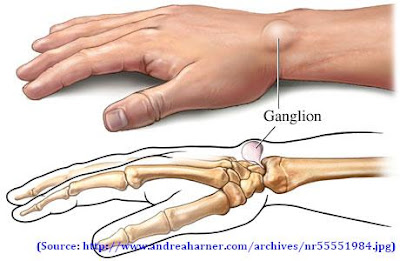 மணிக்கட்டில் கட்டி Ganglion+cyst