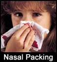 மூக்கால் இரத்தம் வடிதல் (Epistaxis) Nasal+packing+big