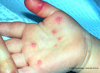 கை கால் வாய்ப்புண் நோய் (Hand Foot and Mouth Disease) Hand+foot+and+mouth+disease+1