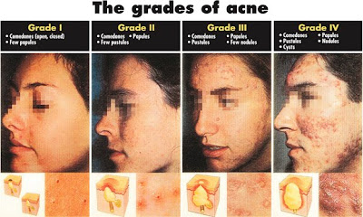 Graus de acne