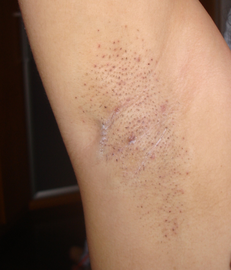 Coisas de mulherzinhas: Depilaçao a laser - day after