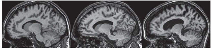 Brain scans of unaffected, early HD and advanced HD patients