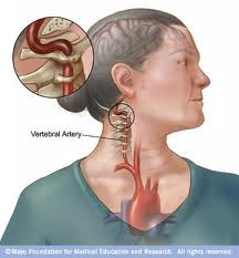 info herba, amalan & petua: Stroke dan kebas kaki tangan