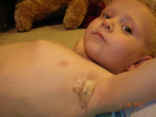 After the ICD implant- One of the scars...