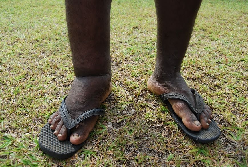 Elephantiasis | Forester life~PNG~Indonesia~Vietnam~world