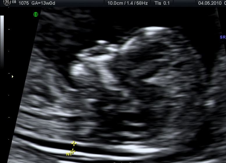 pregnant in dubai nuchal translucency and screening for nuchal translucency