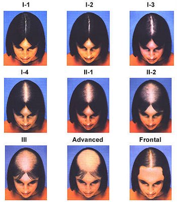 2020 Hair Loss Types Of Baldness