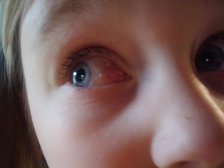 Eye Blister Pictures