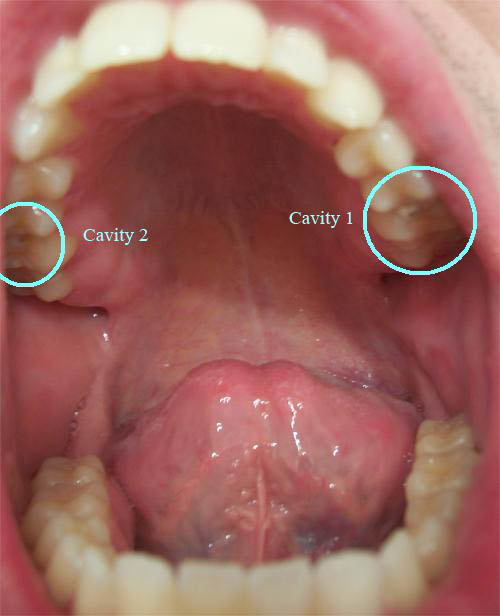 cavity pictures