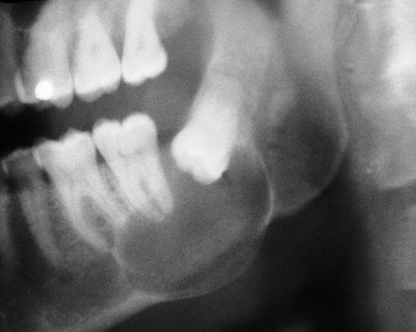 dentigerous cyst