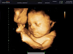 3-D Sonogram