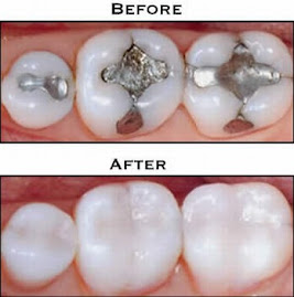Odontología actual: Estetica en resinas compuestas en dientes anteriores