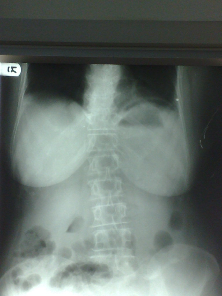 Abnormal gas under left dome of diaphragm Medicine Hack