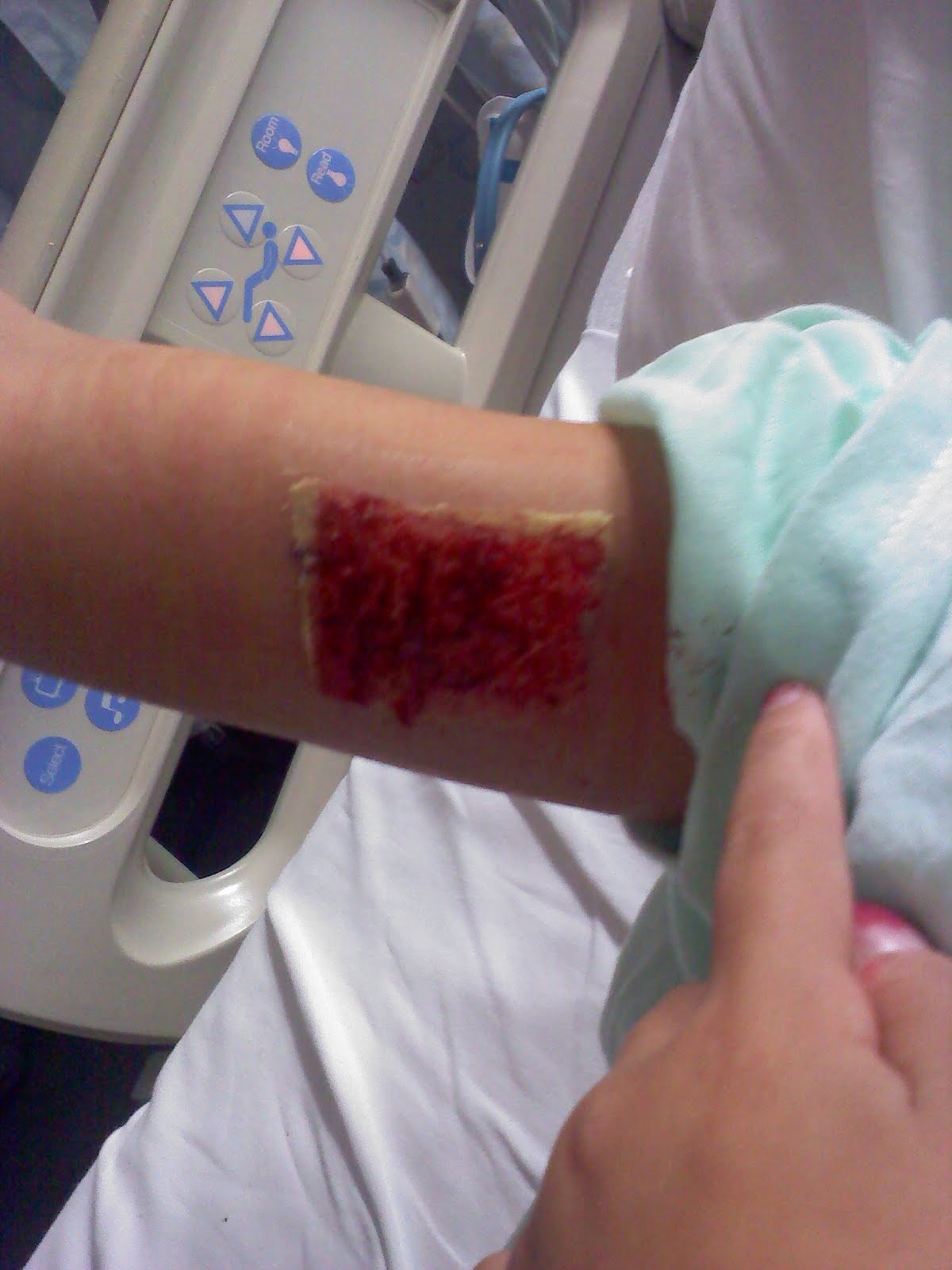 Skin Graft Arm