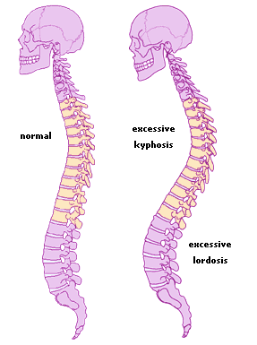 [Image: kyphosis.gif]