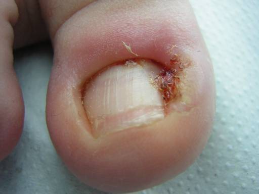 El dolor de los pie del hongo de las uñas