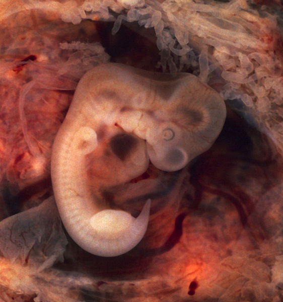 [562px-Tubal_Pregnancy_with_embryo.jpg]