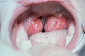tonsils swollen throat tonsil enlarged tonsillectomy tonsillitis removed adenotonsillectomy adenoids child sore kidshealth big when tonsillar causes sleep nz vs