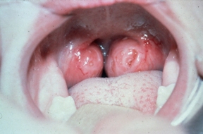 tonsils swollen throat tonsil enlarged tonsillectomy tonsillitis removed adenotonsillectomy adenoids child sore kidshealth big when tonsillar causes sleep nz vs