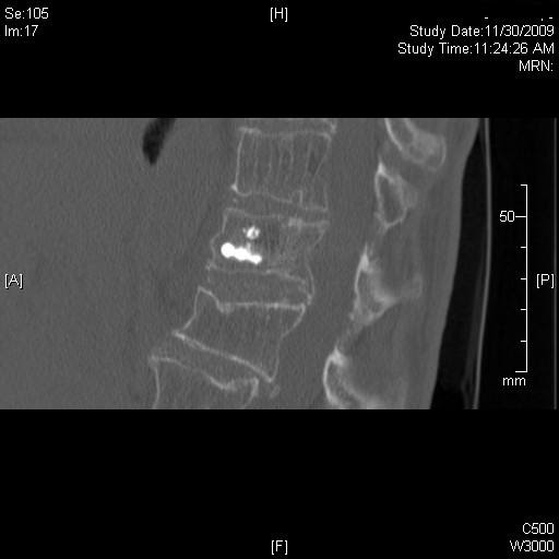 CT Pathology Blog Kyphoplasty for compression fractures of thoracic spine