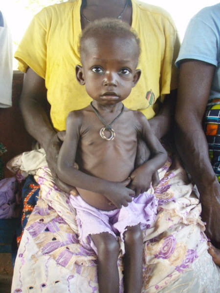 Child suffering from Marasmus