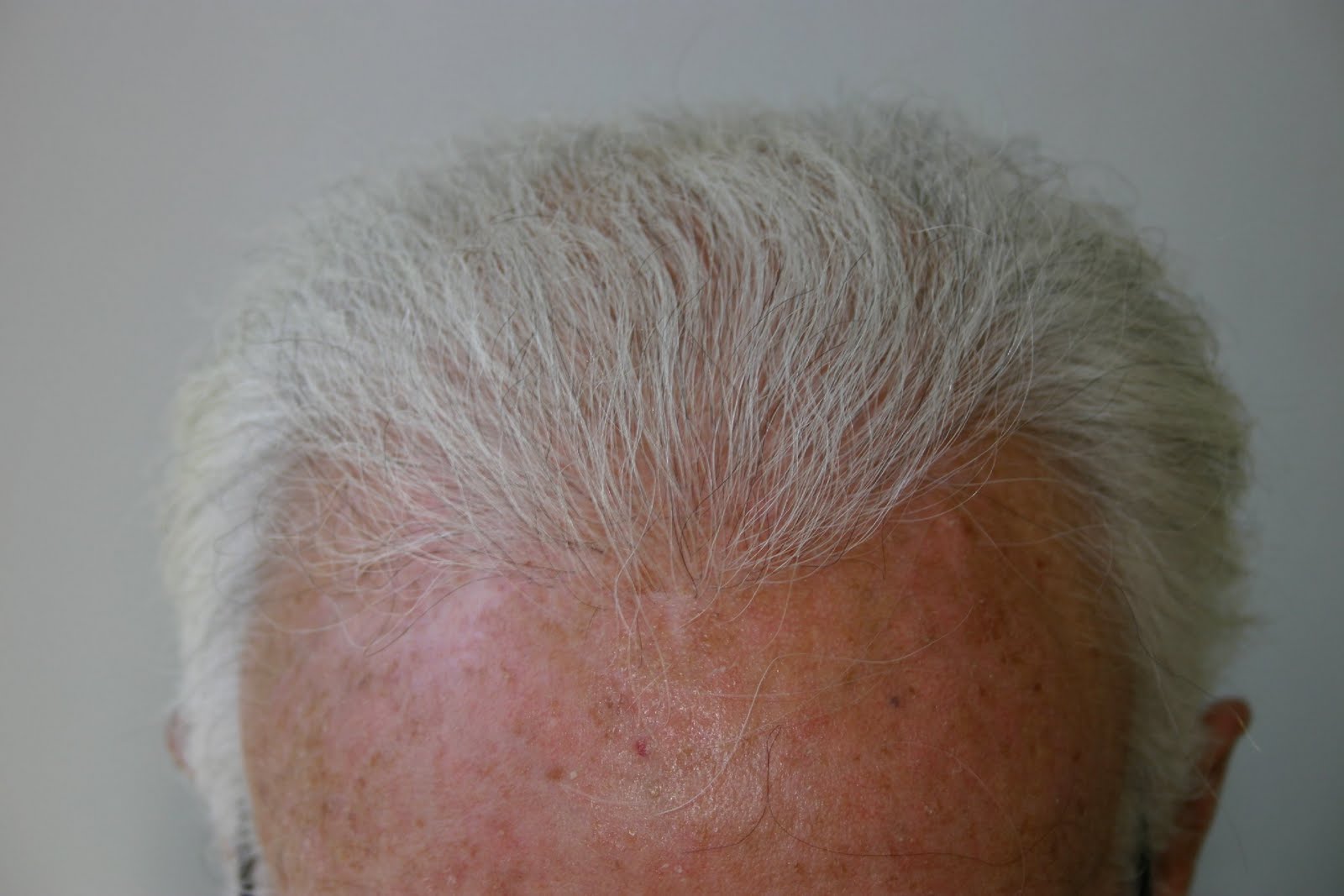 Limmer Hair Transplant HOW OLD IS TOO OLD FOR A HAIR TRANSPLANT?