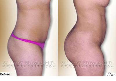 The Buttocks Before & After Weight Loss