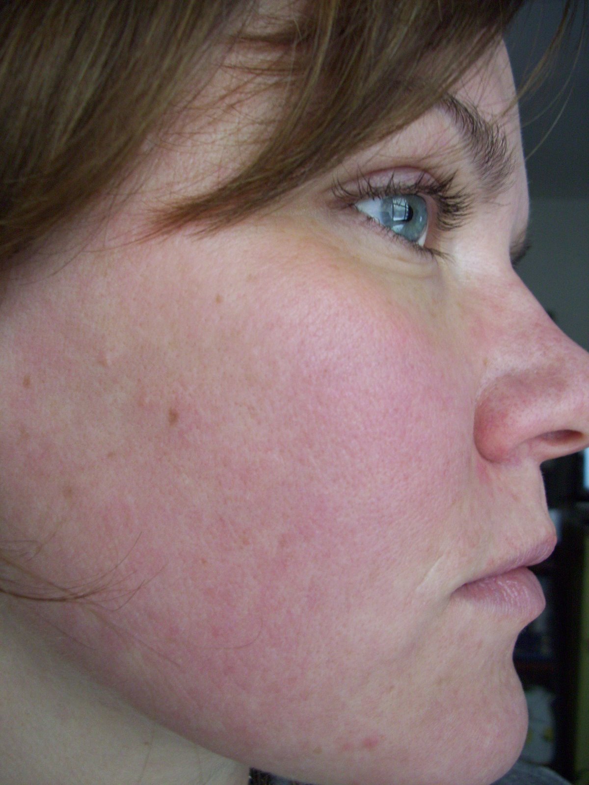 [Post+Pearl+After+Results+Cheek+Chin.JPG]