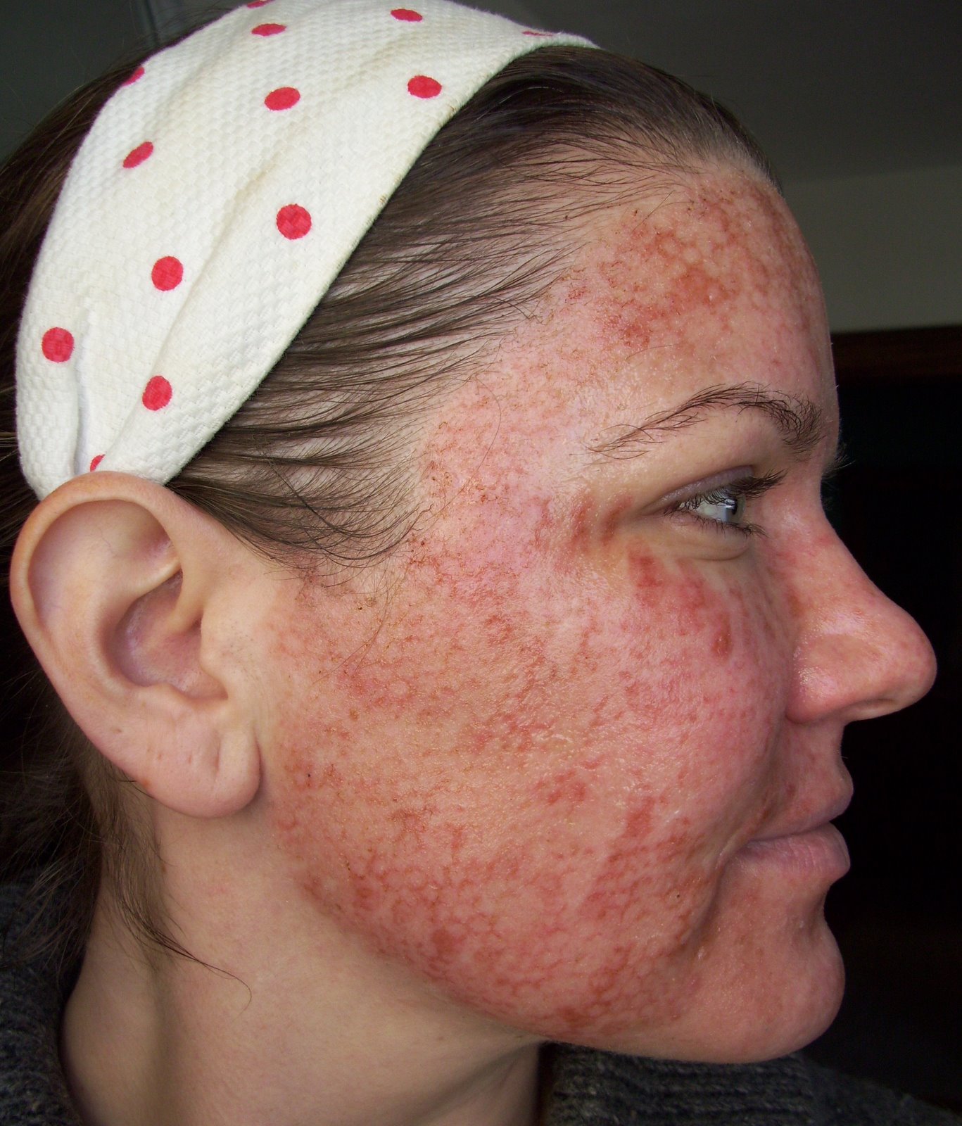 [Post+Pearl+Day+1+Striping+Cheek.JPG]