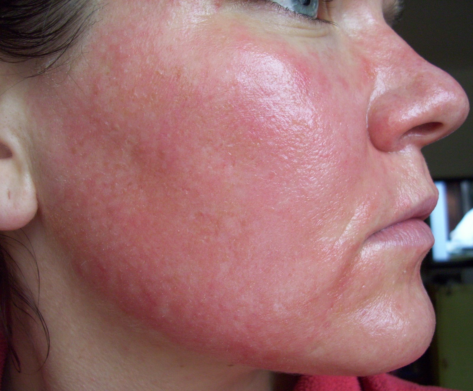 [Post+Pearl+Day+4+Close+Up+Chin.JPG]