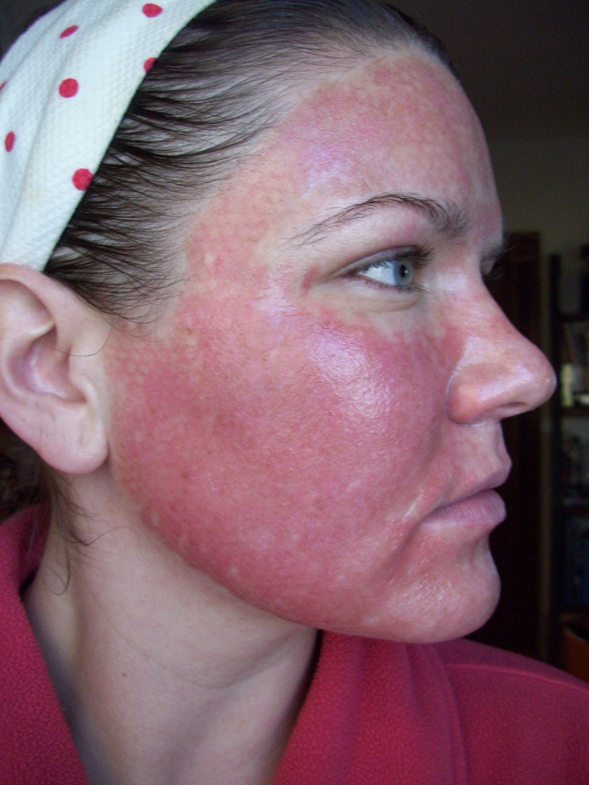 [Post+Pearl+Day+3+Red+Swelling+Cheek.JPG]