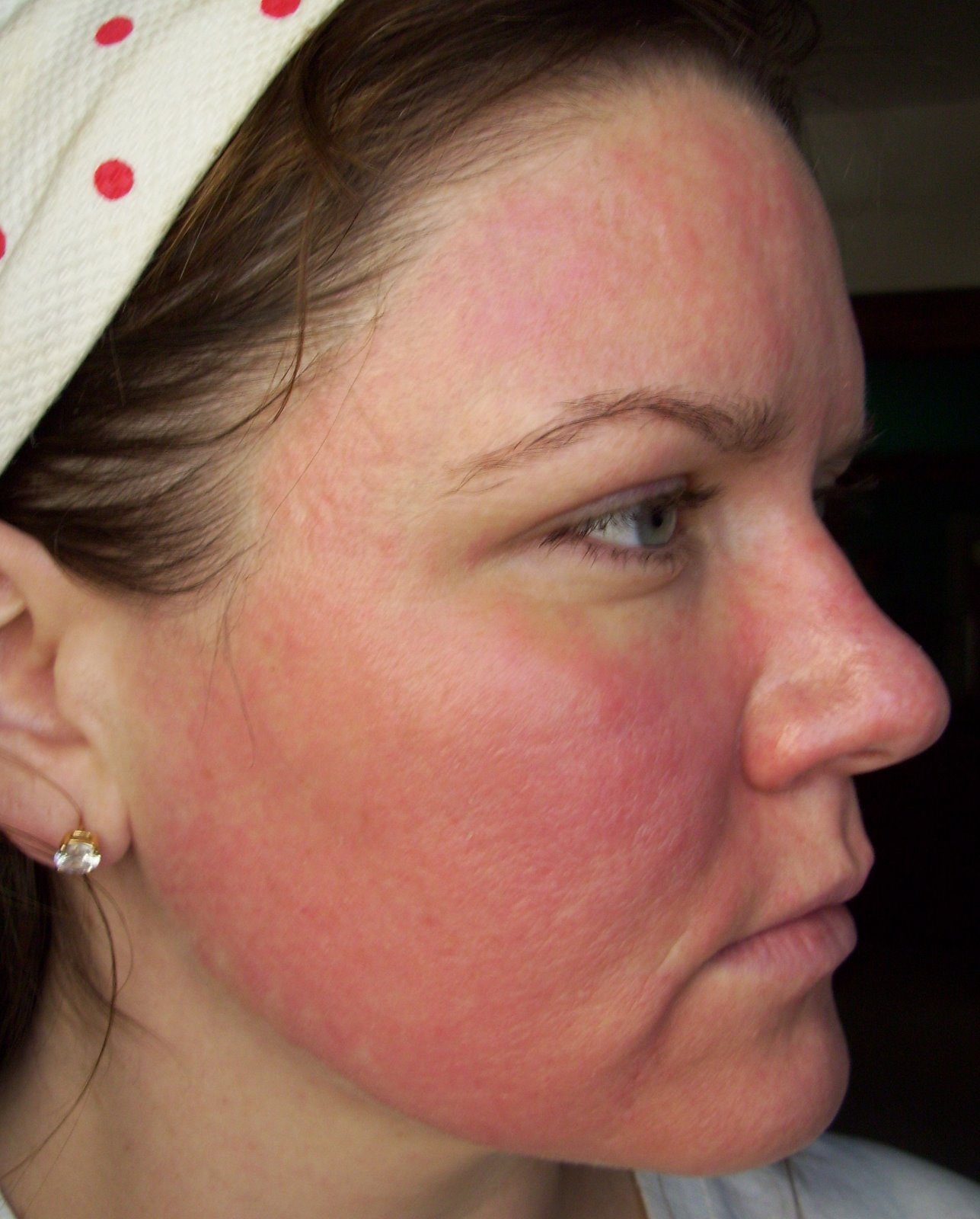 [Post+Pearl+Day+5+Cheek.JPG]