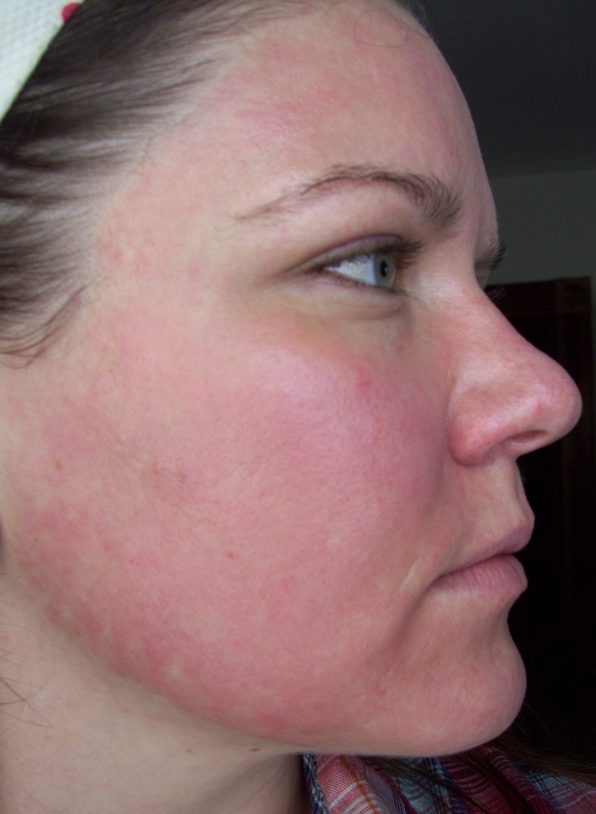 [Post+Pearl+Day+6+Cheek.JPG]