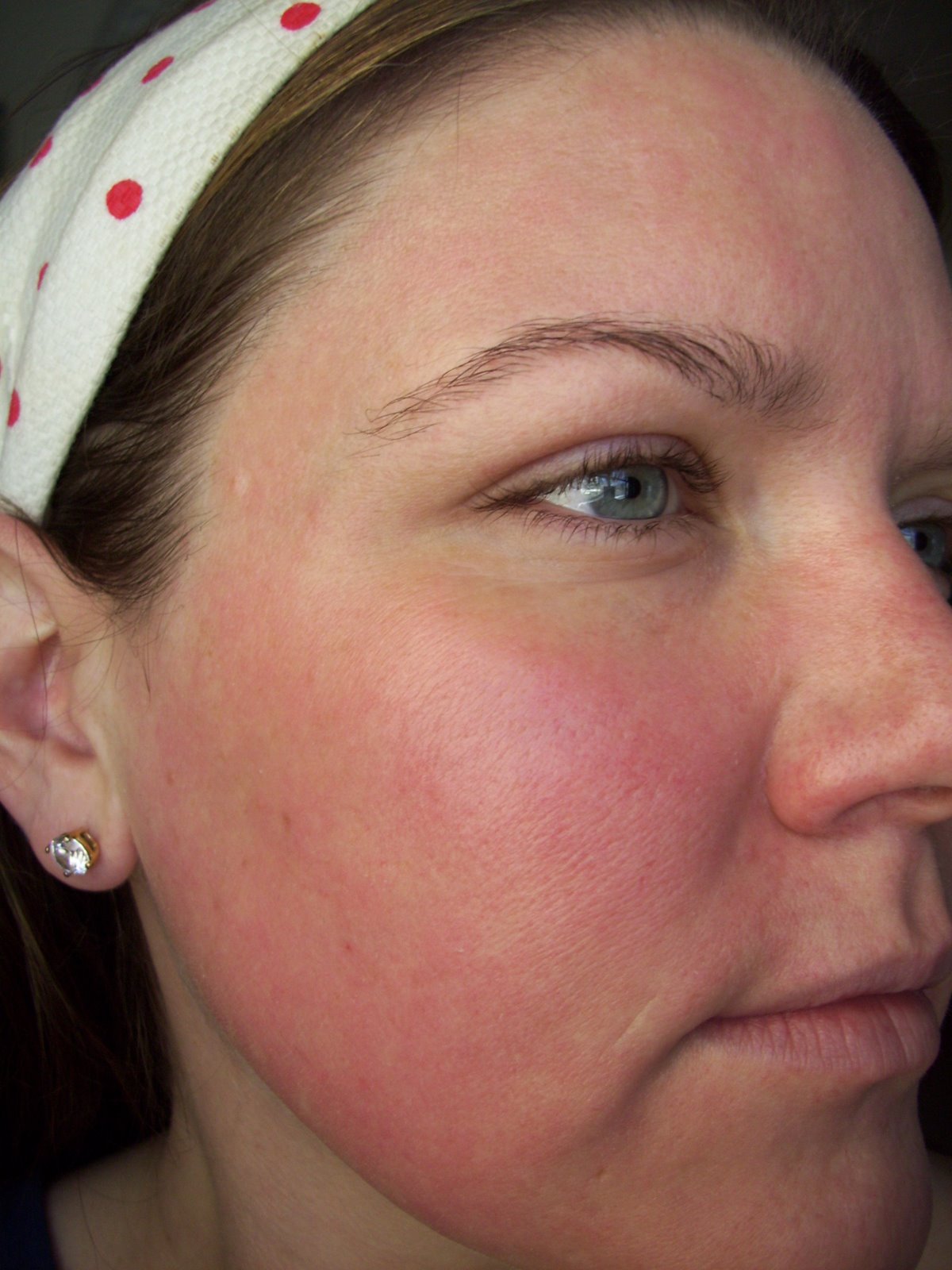 [Post+Pearl+Day+7+Cheek+Eye.JPG]